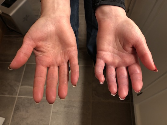 Two hands side by side one looks normal and the other is swollen and will not open all of the way with the palm side up.