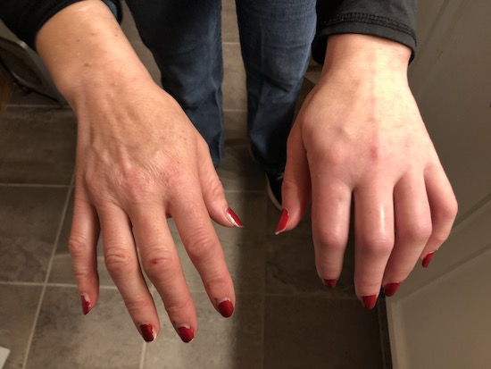 Two hands side by side with the one on the right looking normal and the one on the left swollen, discolored with a limited range of motion