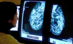 Cancer drug left on shelf<br>Embargoed to 0001 Monday September 29 File photo dated 15/06/06 of a consultant analyzing a mammogram as NHS health officials have been slammed for leaving a cheap breast cancer drug “on the shelf” after experts estimated that 4,000 cases could be prevented every year if women were offered a wider range of preventative medication. PRESS ASSOCIATION Photo. Issue date: Monday September 29, 2014. See PA story HEALTH Breast. Photo credit should read: Rui Vieira/PA Wire