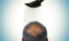 The back view of a man's head who is balding