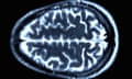 Normal brain. Coloured magnetic resonance imaging (MRI) scan of an axial section through a healthy brain. The front of the brain is towards top of the image. Seen here is the cerebrum, the largest part of the brain. It is divided into two cerebral hemispheres and is responsible for conscious thought, emotion and voluntary movement.
Special instructions
Not Released (NR)
Taken on
23 Feb 2013, 00:00
By
PASIEKA