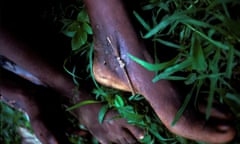 Extraction of a Guinea Worm Benin<br>2J86164 Extraction of a Guinea Worm Benin