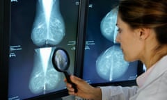 A doctor looks at mammogram results with a magnifying glass.