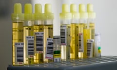 Researchers have developed a urine test for early-stage pancreatic cancer.