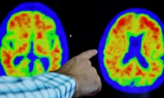 Evidence of Alzheimer’s disease on Pet scans.