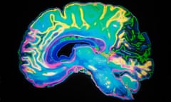 MRI scan human brain