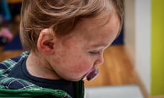 Side view  of a girl who is wearing a shirt with measles