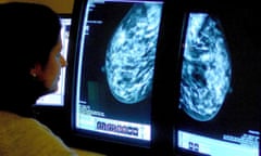 Breast cancer scan