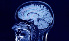 Brain head scan