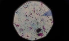 A sample that tested positive for tuberculosis is seen under a microscope