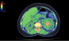 A CT scan showing a renal stone in a patient’s left kidney (pink spot, right of image).