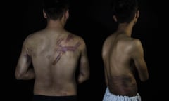 Two journalists show wounds sustained at the hands of the Taliban in 2021.