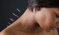 A woman with acupuncture needles in her back