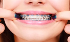 Woman showing her teeth with braces