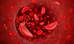 Illustration of sickle cells in blood flow. 