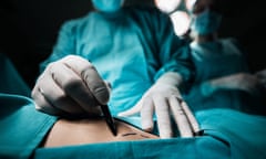 Close up of a plastic surgeon marking the human skin for surgery.