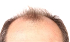 A balding man’s head.