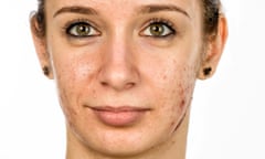 Woman with acne