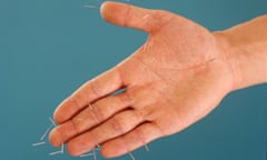 A hand with acupuncture needles