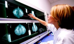 A radiologist examines mammograms for signs of breast cancer