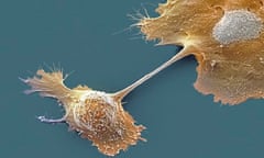 Pancreatic cancer cells. Despite attempts to improve the NHS record on treatment of the cancer, suff