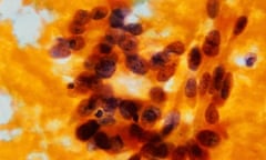 cervical cancer, abnormal cells