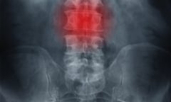 X-ray showing back ache