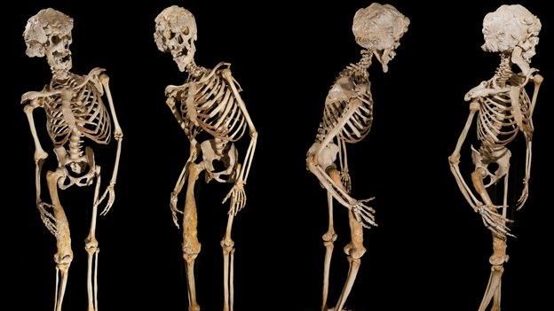 four views of Joseph Merrick's skeleton