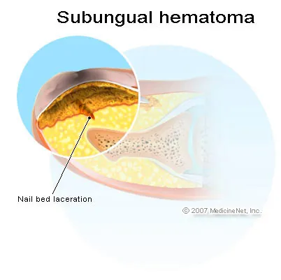 Picture of a subungual hematoma