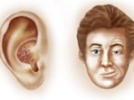 Ramsay Hunt syndrome (RHS) is a rare neurological disorder accompanied by paralysis of the facial nerve (facial palsy) and a rash affecting the ear or mouth but there is not much awareness regarding it. The varicella-zoster virus is the factor causing Ramsay Hunt syndrome and it is the same virus that leads to chickenpox and shingles. If one has this syndrome then the virus will infect the facial nerve near the inner ear which causes irritation and swelling of the nerve. It is seen in adults and occurs rarely in children. In an interview with HT Lifestyle, Dr Pavan Pai, Interventional Neurologist at Wockhardt Hospitals, Mira Road, revealed, “The symptoms of it are ear pain, rash on the eardrum, ear canal, earlobe, tongue, and roof of the mouth on the side with the affected nerve, hearing loss on one side, vertigo, facial paralysis, and problems in opening the eyes.” (Twitter/DrAo94)