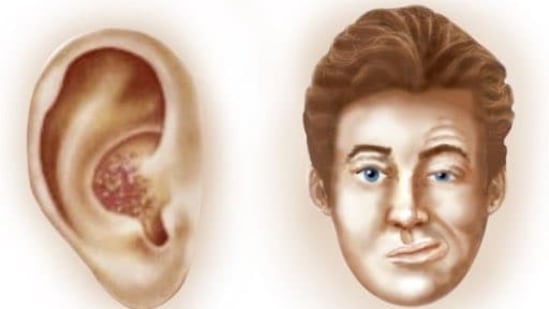 Ramsay Hunt syndrome (RHS) is a rare neurological disorder accompanied by paralysis of the facial nerve (facial palsy) and a rash affecting the ear or mouth but there is not much awareness regarding it. The varicella-zoster virus is the factor causing Ramsay Hunt syndrome and it is the same virus that leads to chickenpox and shingles. If one has this syndrome then the virus will infect the facial nerve near the inner ear which causes irritation and swelling of the nerve. It is seen in adults and occurs rarely in children. In an interview with HT Lifestyle, Dr Pavan Pai, Interventional Neurologist at Wockhardt Hospitals, Mira Road, revealed, “The symptoms of it are ear pain, rash on the eardrum, ear canal, earlobe, tongue, and roof of the mouth on the side with the affected nerve, hearing loss on one side, vertigo, facial paralysis, and problems in opening the eyes.” (Twitter/DrAo94)