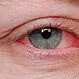 Picture of Eye Allergies