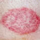 Ringworm Quiz: Test your Medical IQ