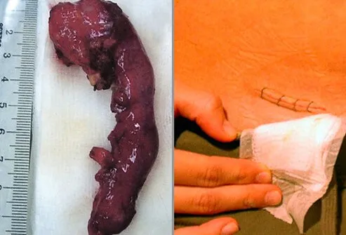 Potential Complications of Appendectomy