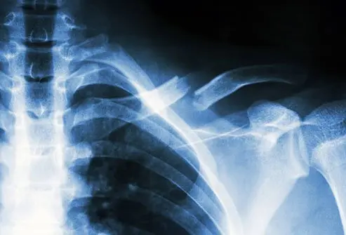 Picture of Bone Fracture