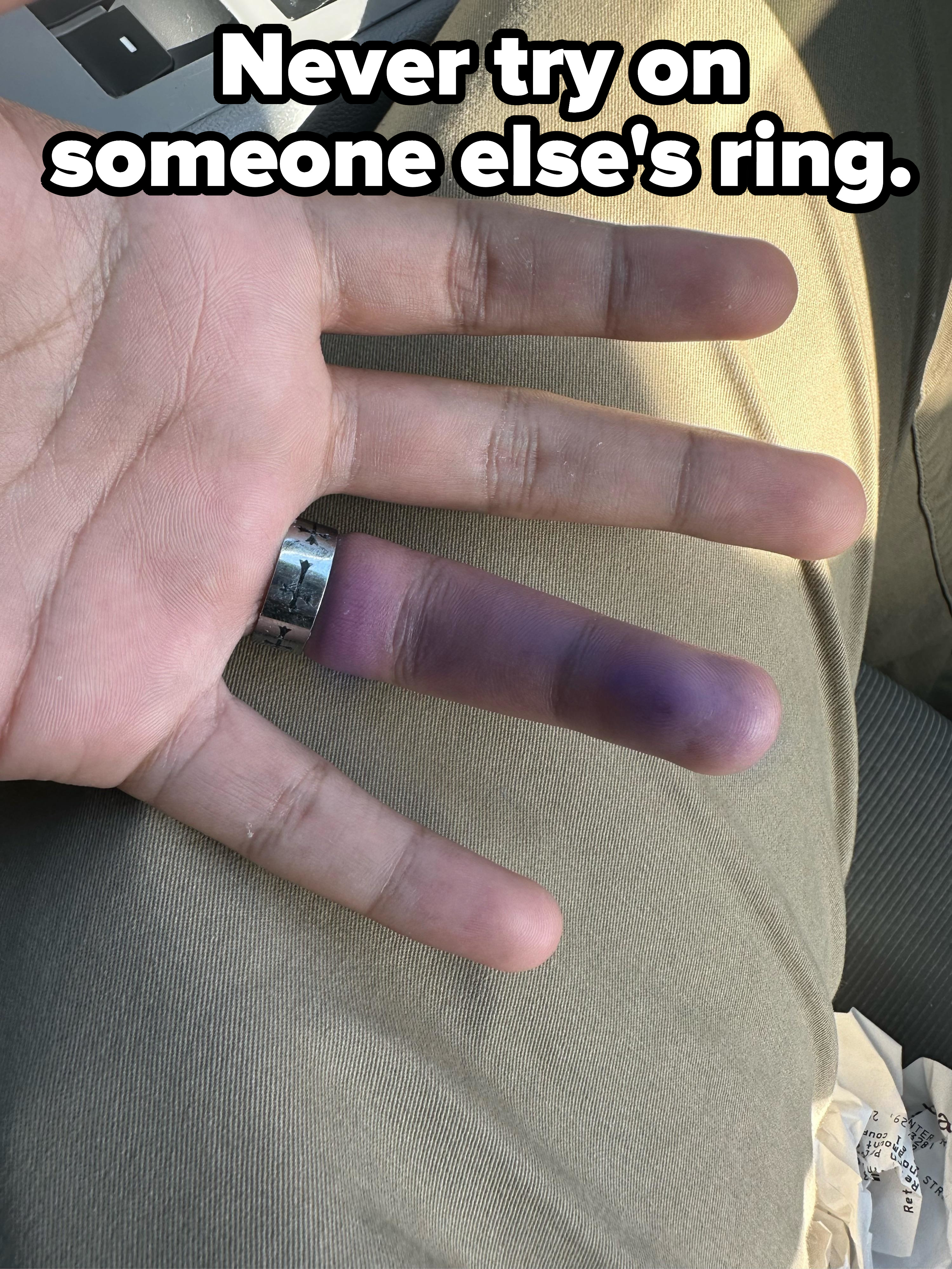 hand with a ring cutting off circulation to a purple finger