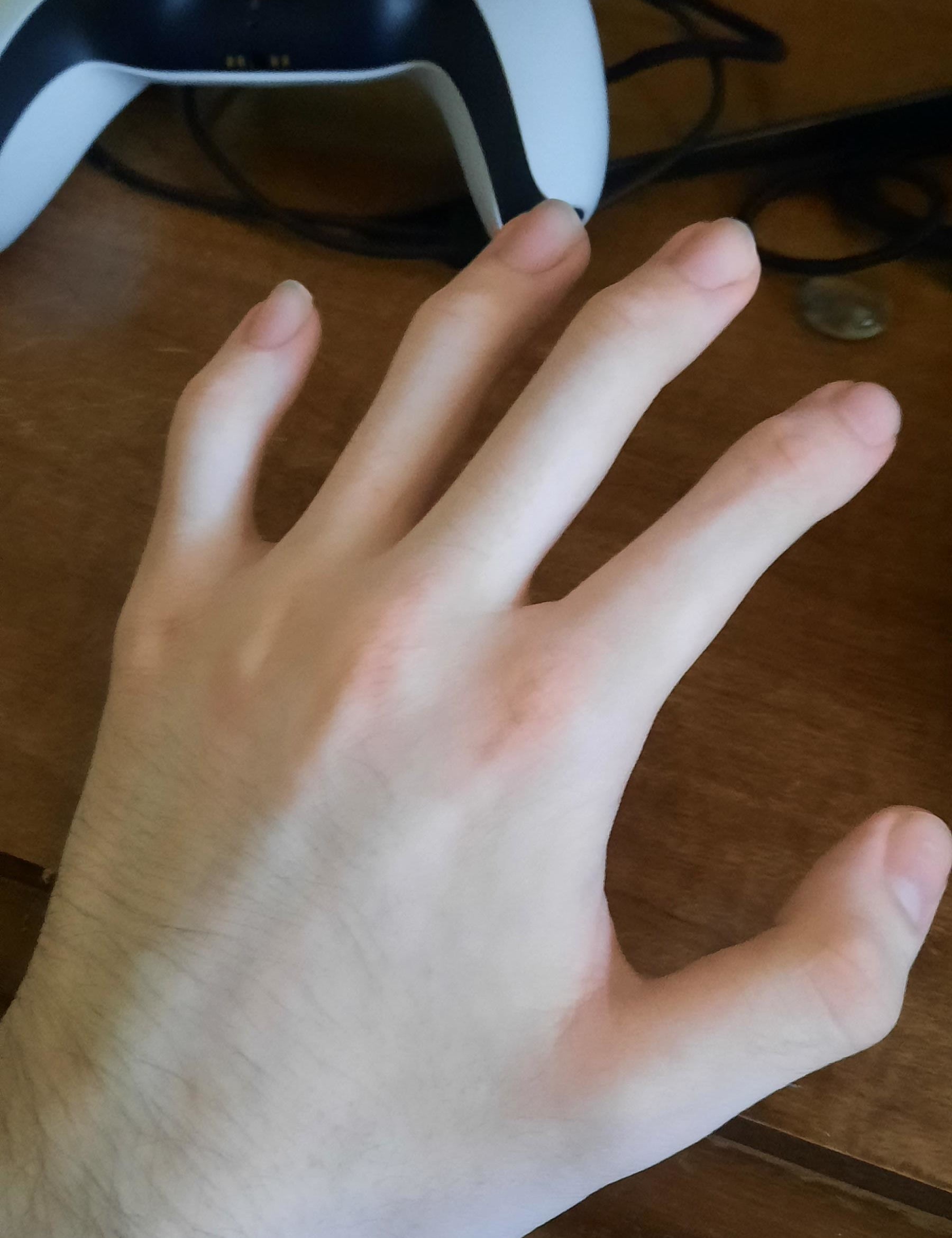 no middle knuckles on a hand