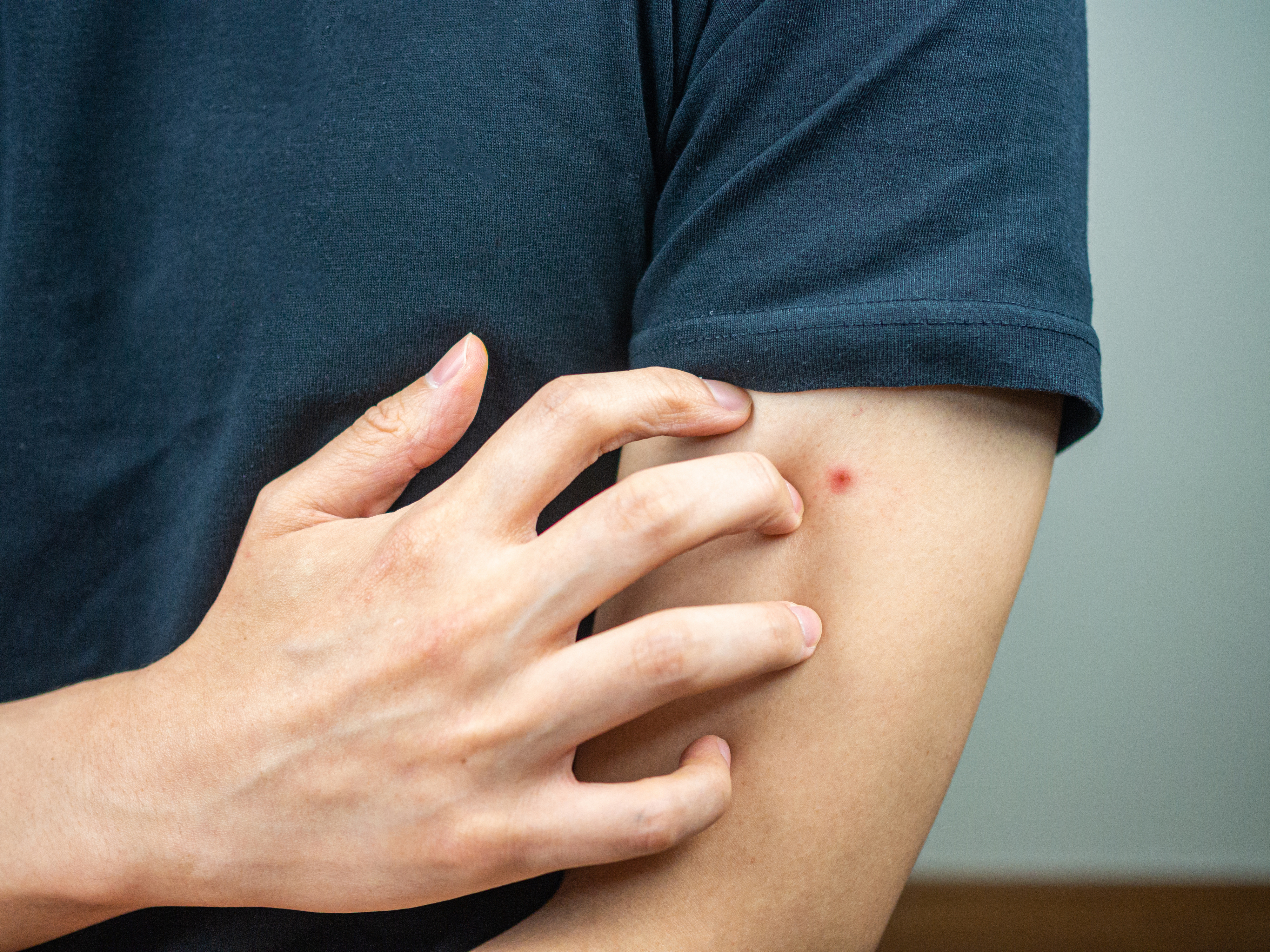 person scratching a bite on their arm