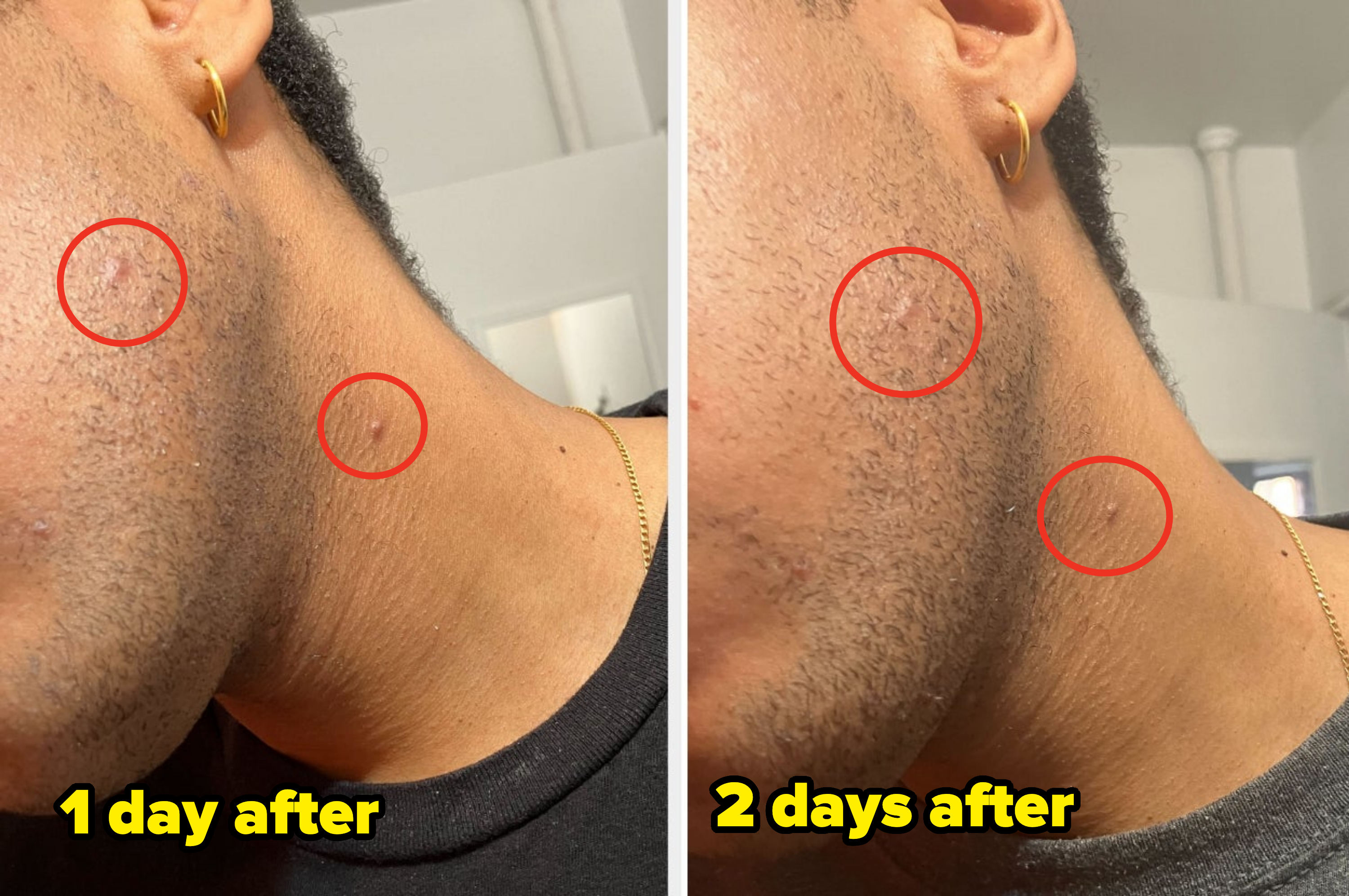 Close-up comparison of a person&#x27;s jawline and neck before and after skincare treatment, showing noticeable improvement in skin texture and reduction of blemishes