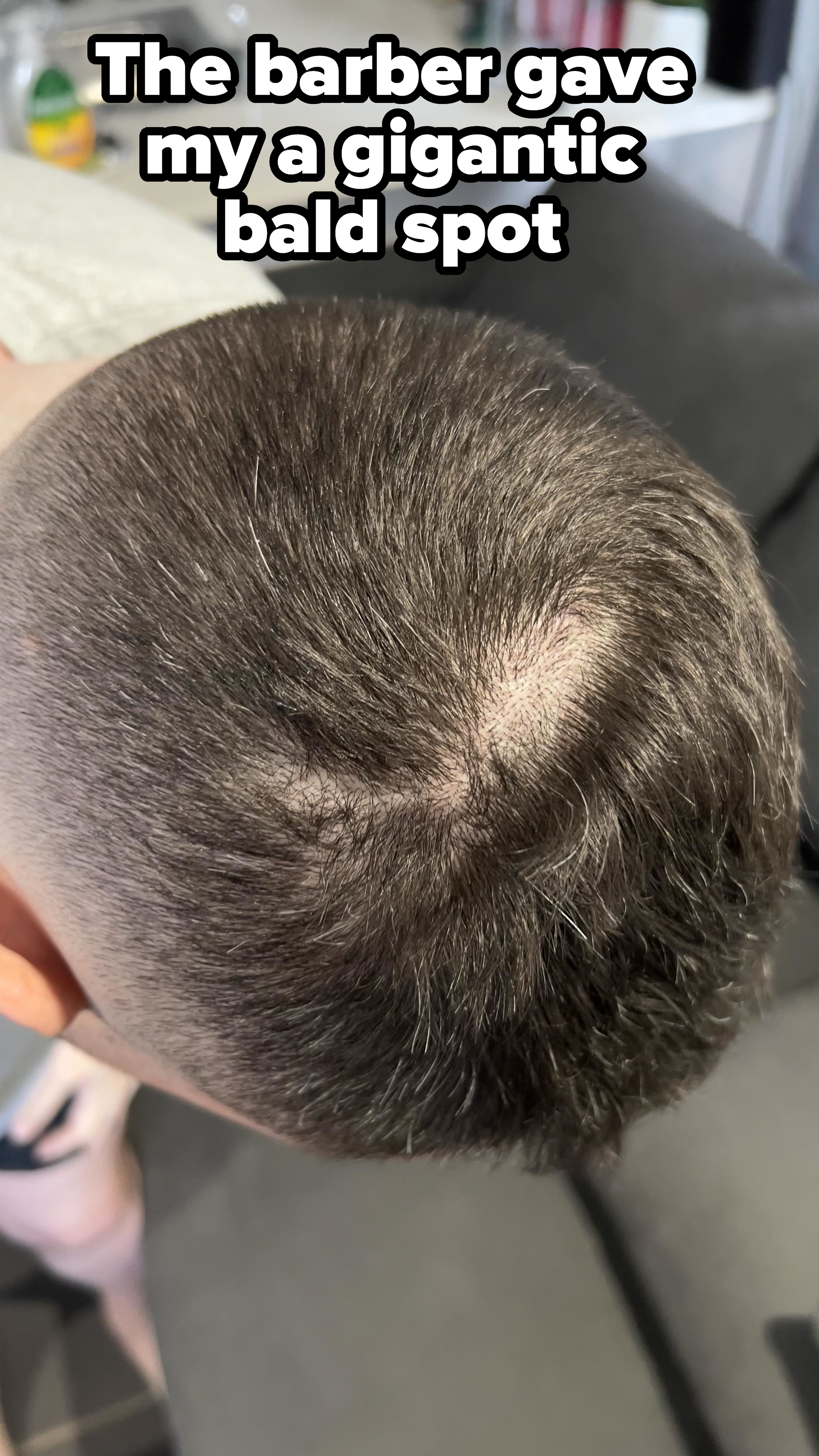 A close-up view of the top of a person&#x27;s head showing thinning hair and a visible patch of scalp