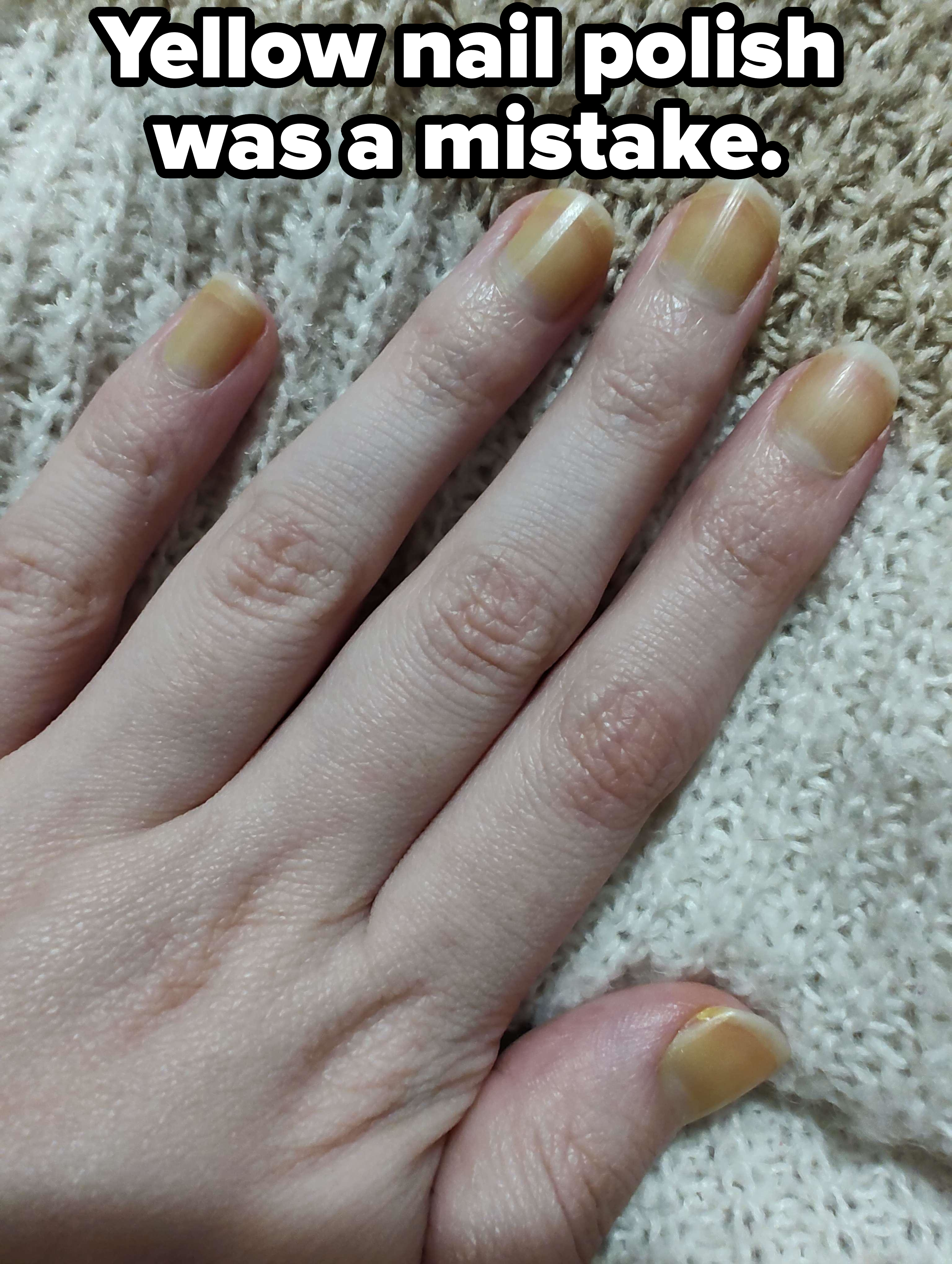 A close-up of a person&#x27;s hand with yellow-tinted nails, placed on a knitted fabric background. The image shows irregular nail coloration