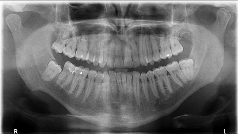 Panoramic dental X-ray showing a full set of adult teeth, including upper and lower jaws, with some dental work visible