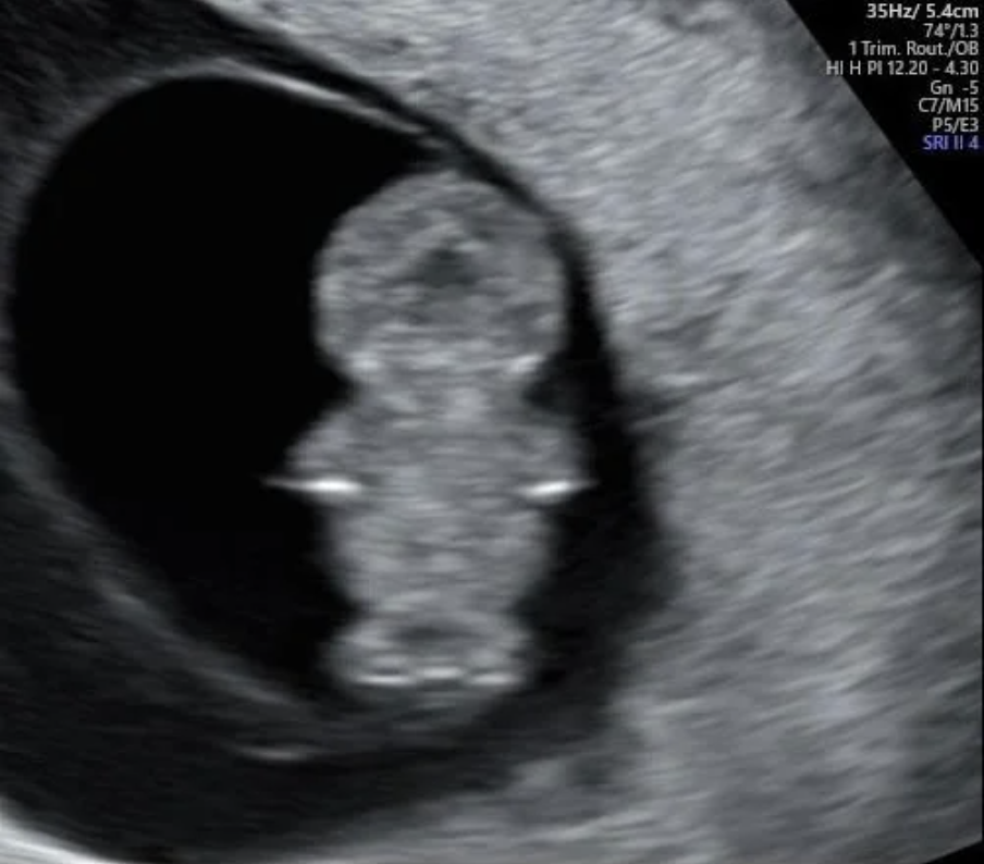 Ultrasound image showing a developing human fetus. Medical details and measurements are visible at the top of the image