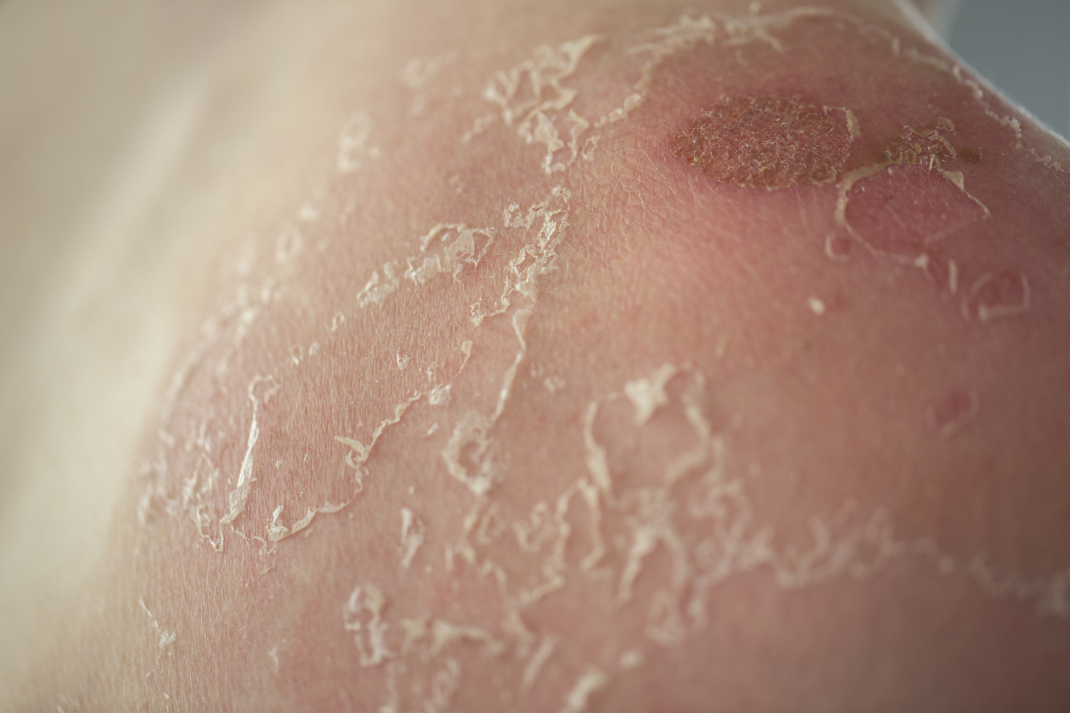 Close-up image of flaky, peeling skin on a person&#x27;s shoulder, appearing dry and irritated with a small red patch. No known individuals are in the image