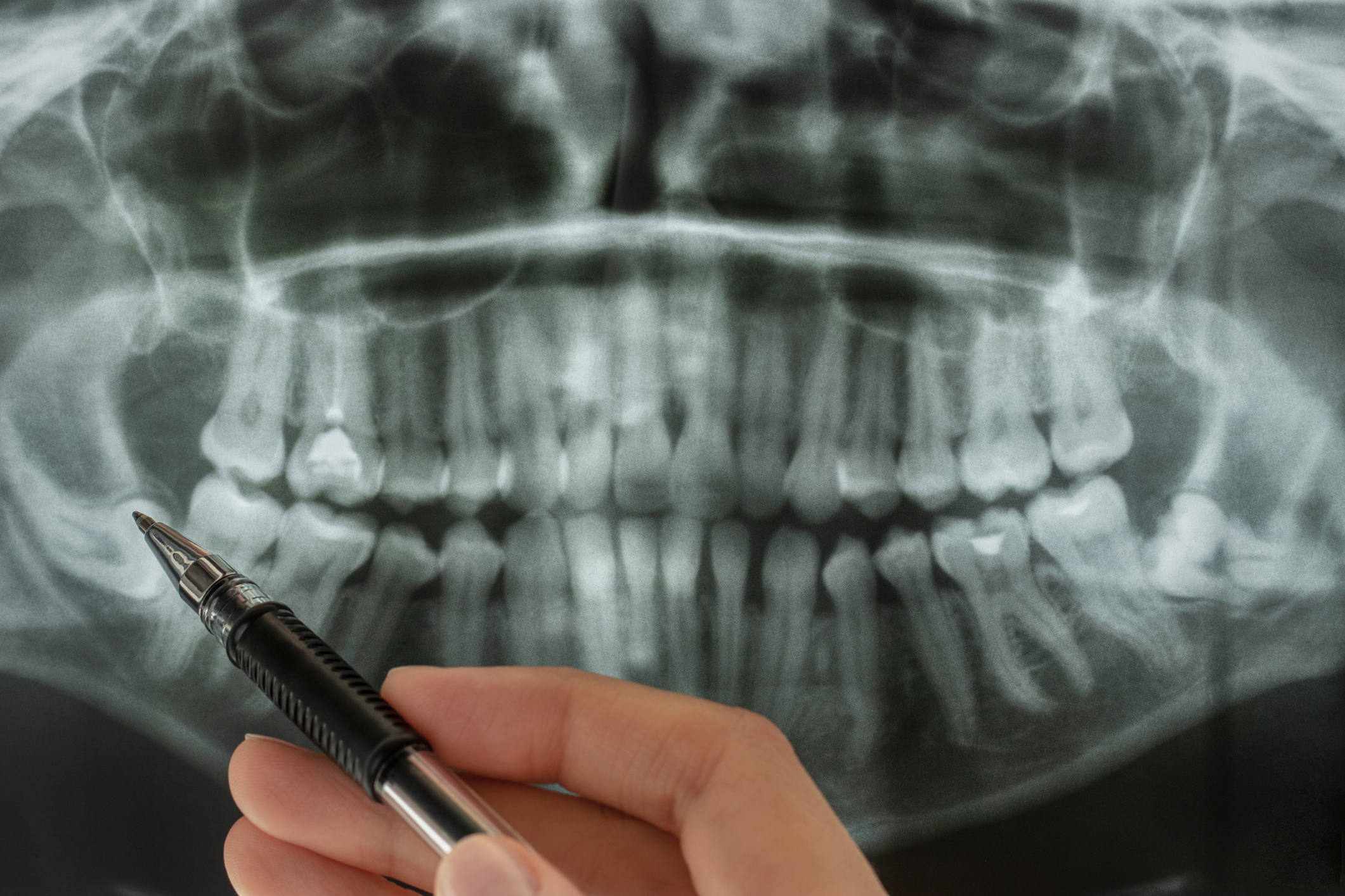 A hand holds a pen pointing at a dental X-ray showing a full set of adult teeth, highlighting the detailed view of the jaw and teeth alignment