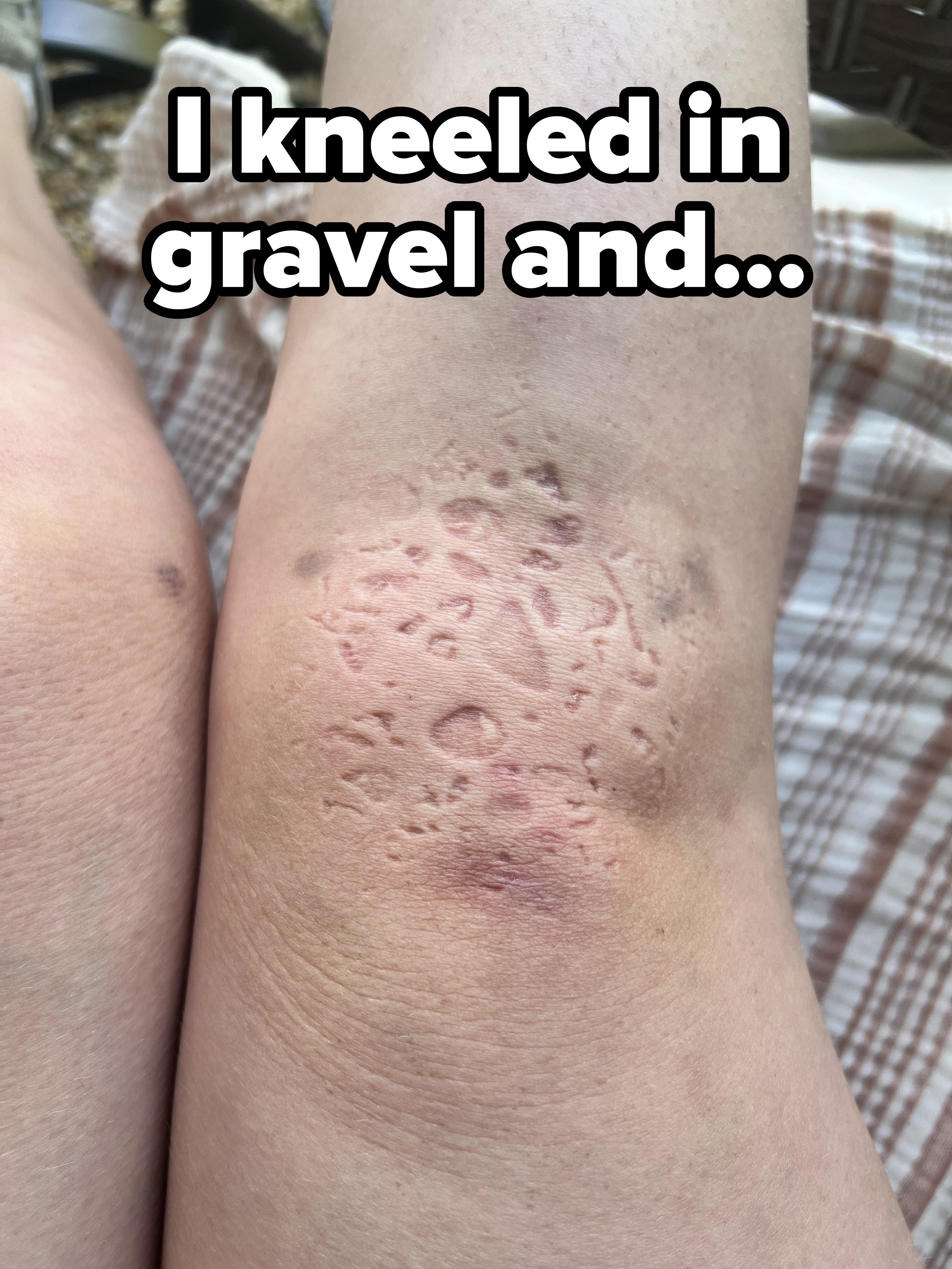 The image shows a close-up of a person&#x27;s skin with a visibly rough, dry patch on the knee that appears to be irritated or inflamed