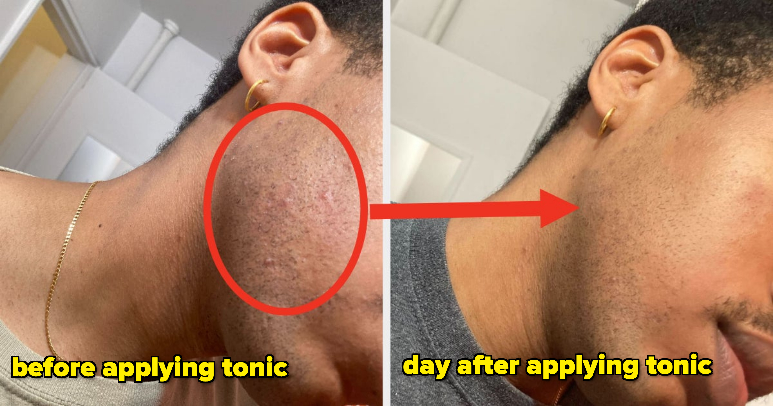 Close-up of a person&#x27;s cheek showing a before image on the left with acne scars circled in red and an after image on the right with clearer skin and an arrow pointing from left to right