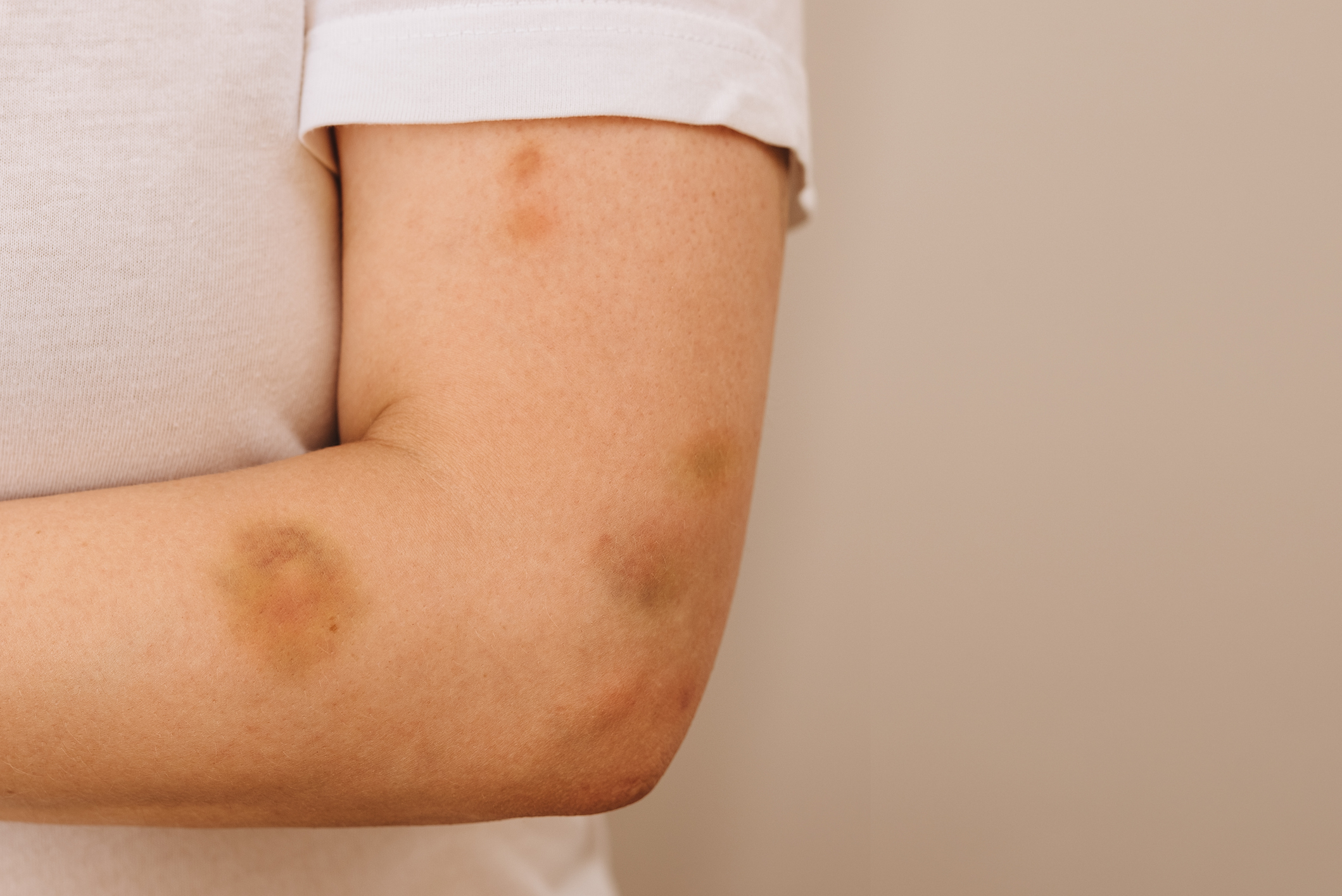 Close-up image of a person&#x27;s arm showing multiple bruises