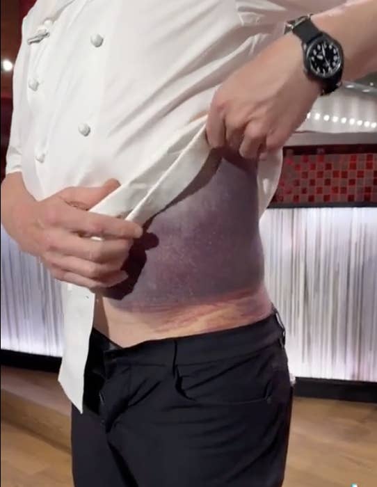 A person lifts their shirt to reveal a large bruise on their side in a kitchen setting. The person&#x27;s face is not visible