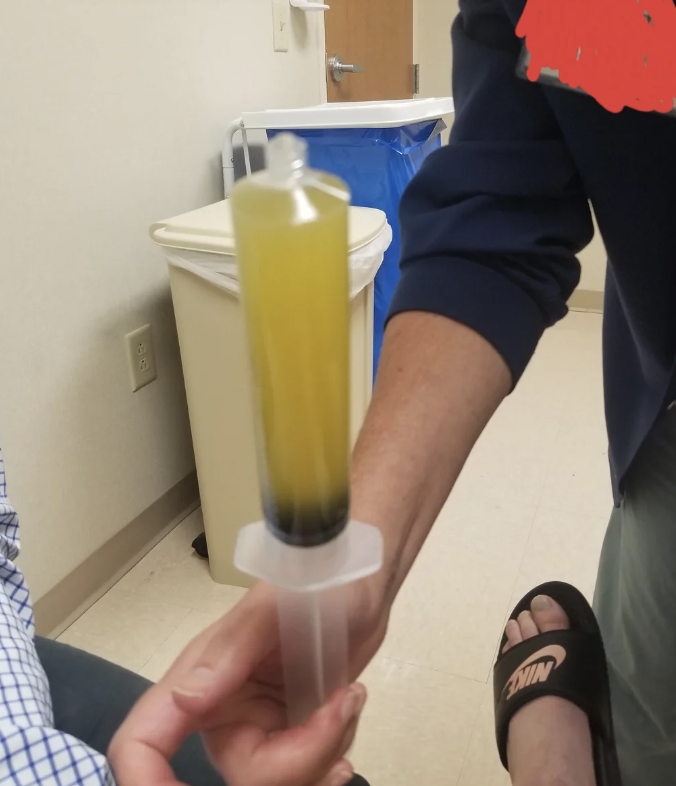 A person holds a large syringe filled with a yellow liquid. Another person, partially in view, is seated nearby. The setting appears to be a medical environment
